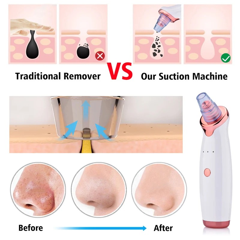 Dispositif de nettoyage des points noirs - Élimination efficace et sans douleur